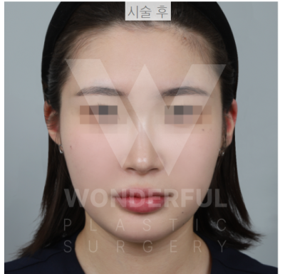 요즘 대세 요정 귀 " 진짜 효과 좋나요?"  귀 필러 직 후 비교