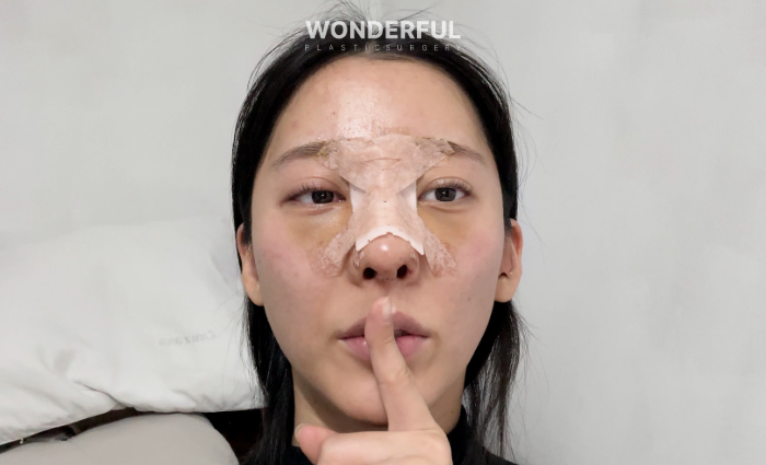 여름휴가 앞두고 코성형, 바닷가 수영장 가도 될까요?