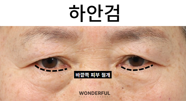 50대 갱년기 회복을 위한 동안 수술 3가지 추천!