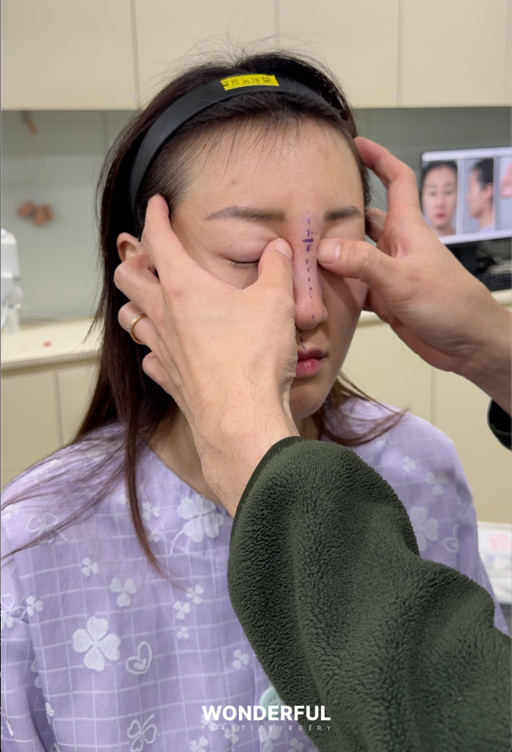 콧대 필러를 맞았는데 코수술이 가능할까요? 사진 5