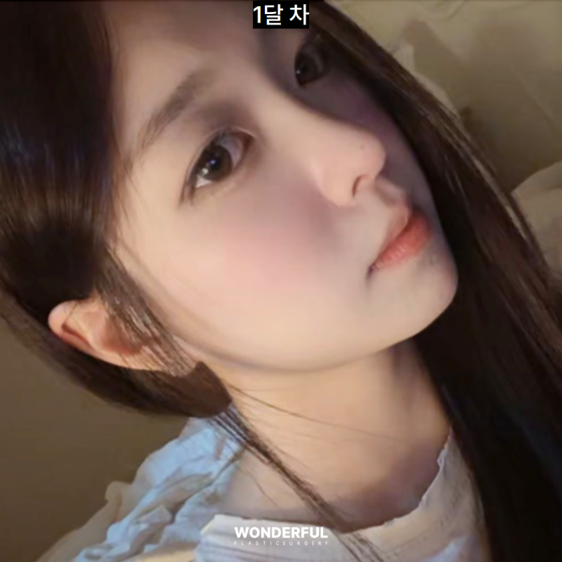 쌍수붓기 빨리 빼는법! 사진 10