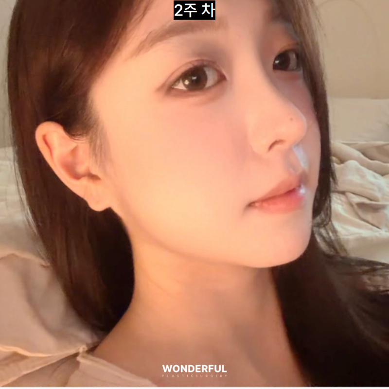쌍수붓기 빨리 빼는법! 사진 9