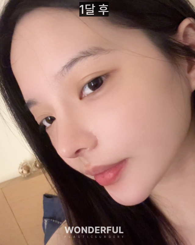 20대인데 벌써 눈밑지방재배치를 해도 될까요? 사진 6