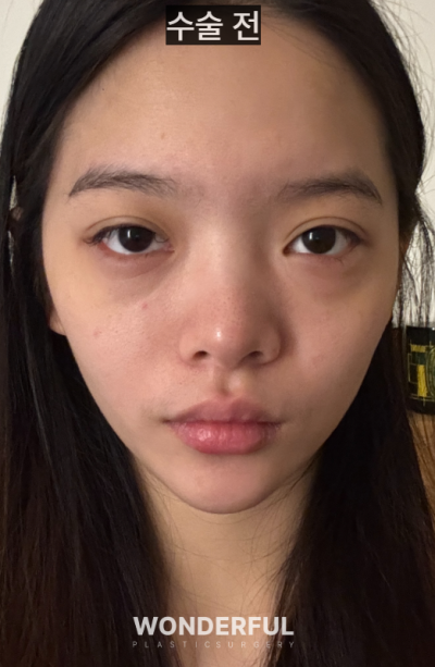 20대인데 벌써 눈밑지방재배치를 해도 될까요? 사진 3