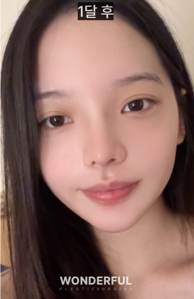 20대인데 벌써 눈밑지방재배치를 해도 될까요? 사진 4
