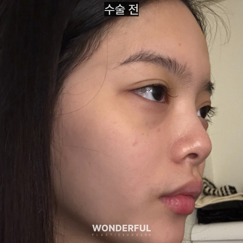 20대인데 벌써 눈밑지방재배치를 해도 될까요?