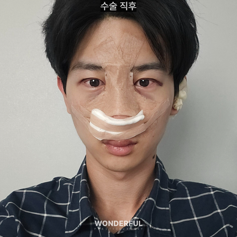 변우석 눈코처럼 성형했습니다. 남자 대변신, 회복 일주일부터 한달 사진 4