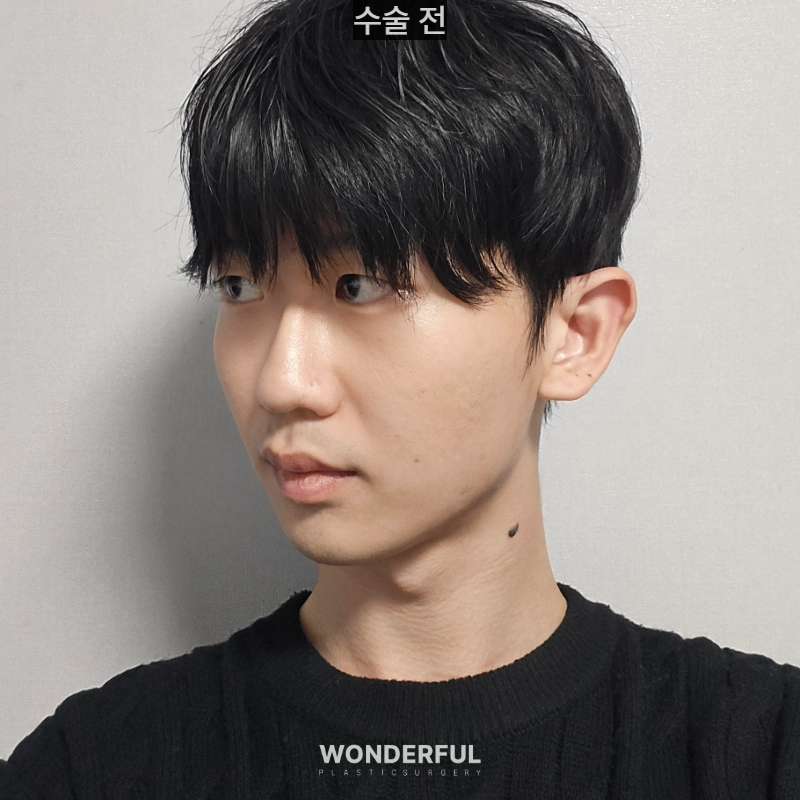 변우석 눈코처럼 성형했습니다. 남자 대변신, 회복 일주일부터 한달 사진 13