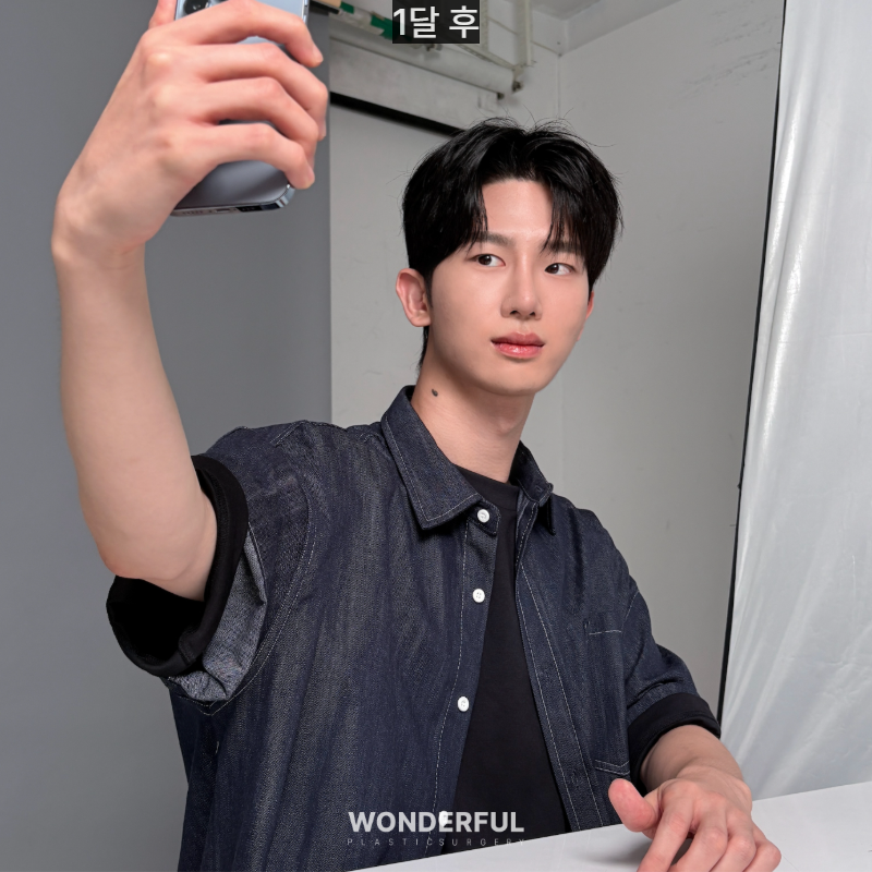 변우석 눈코처럼 성형했습니다. 남자 대변신, 회복 일주일부터 한달 사진 14