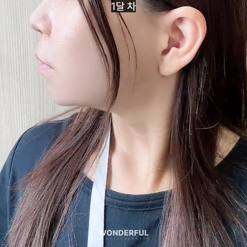 이중턱 때문에 고민이라면? 턱지방흡입! 효과/회복기간 사진 9