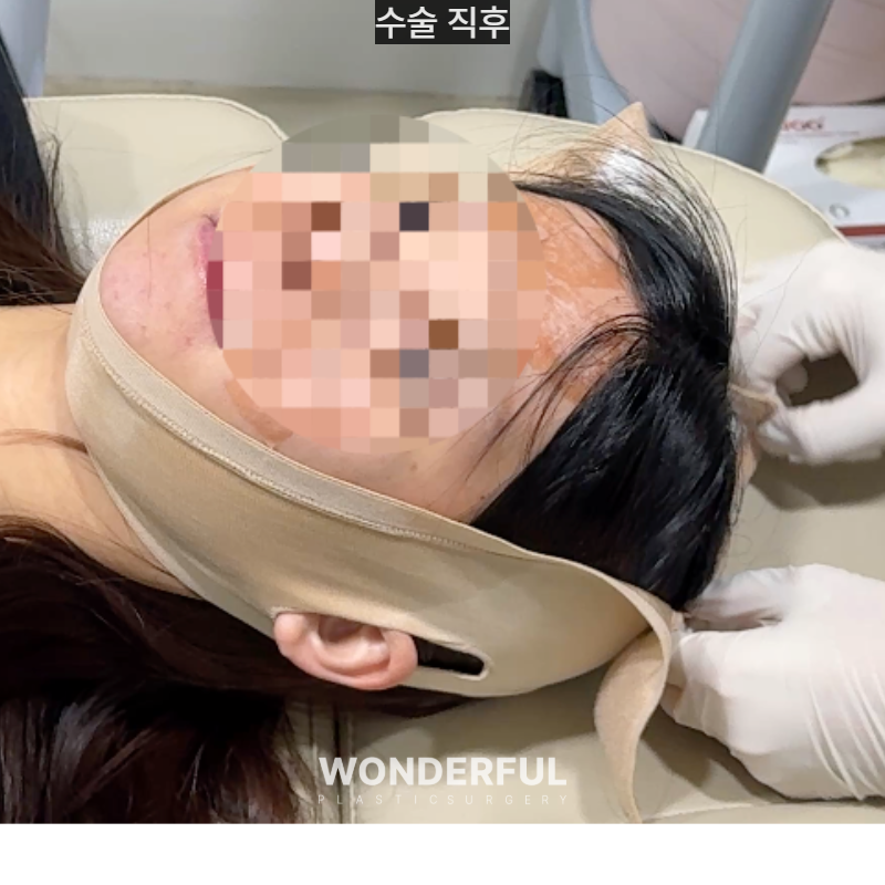 이중턱 때문에 고민이라면? 턱지방흡입! 효과/회복기간 사진 3