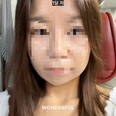 이중턱 때문에 고민이라면? 턱지방흡입! 효과/회복기간 사진 7