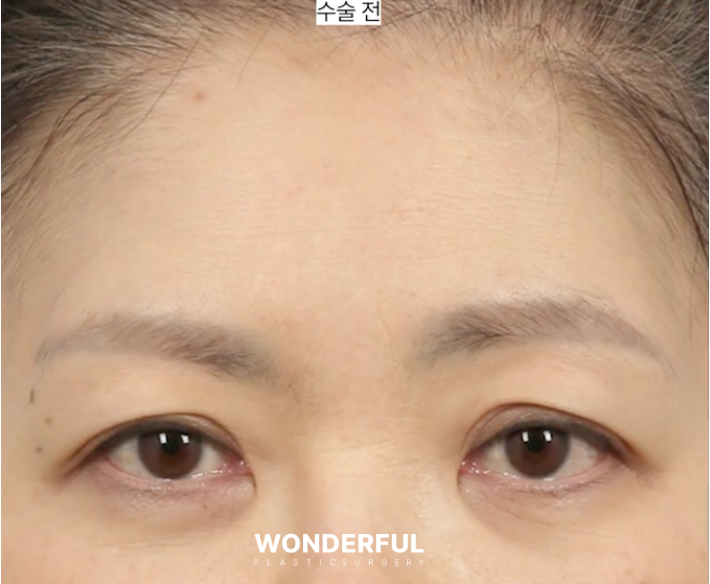눈썹하거상이 필요한 경우! 셀프체크해 보세요. 사진 2