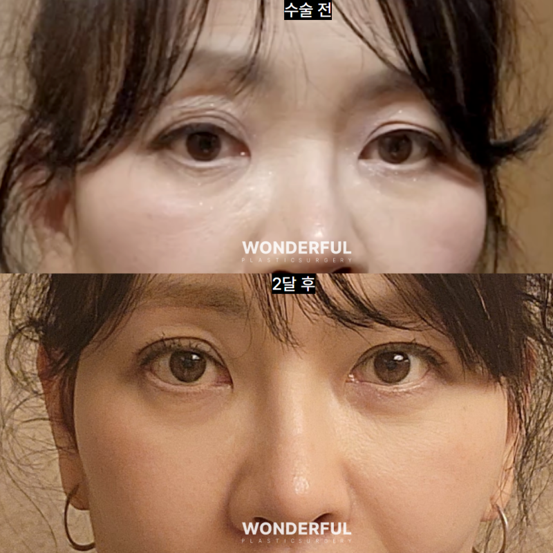 눈썹하거상이 필요한 경우! 셀프체크해 보세요.