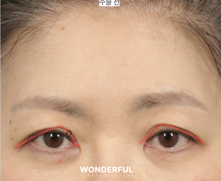 눈썹하거상이 필요한 경우! 셀프체크해 보세요. 사진 4