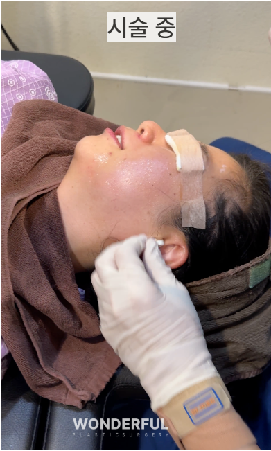 온다리프팅 60KJ, 80KJ, 100KJ 차이점은? 에너지가 높을수록 효과가 좋을까요? 사진 4