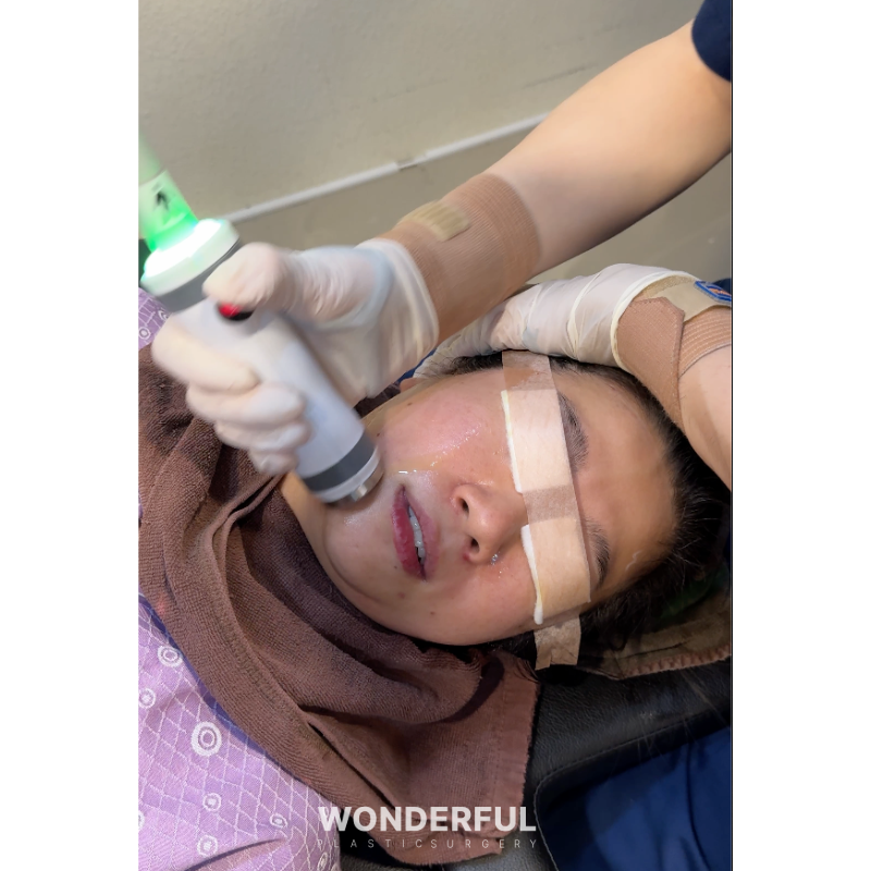 온다리프팅 60KJ, 80KJ, 100KJ 차이점은? 에너지가 높을수록 효과가 좋을까요? 사진 2