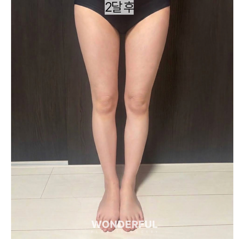 지방흡입하면 아이돌팔 다리 가능할까요? 사진 3