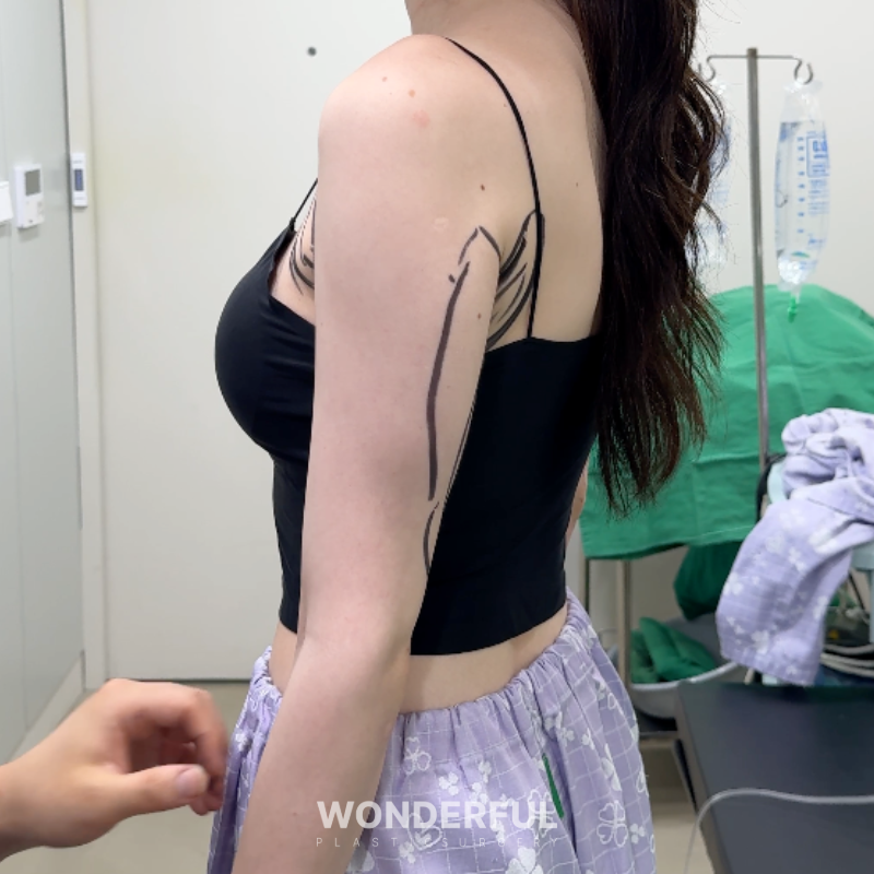 지방흡입하면 아이돌팔 다리 가능할까요? 사진 4