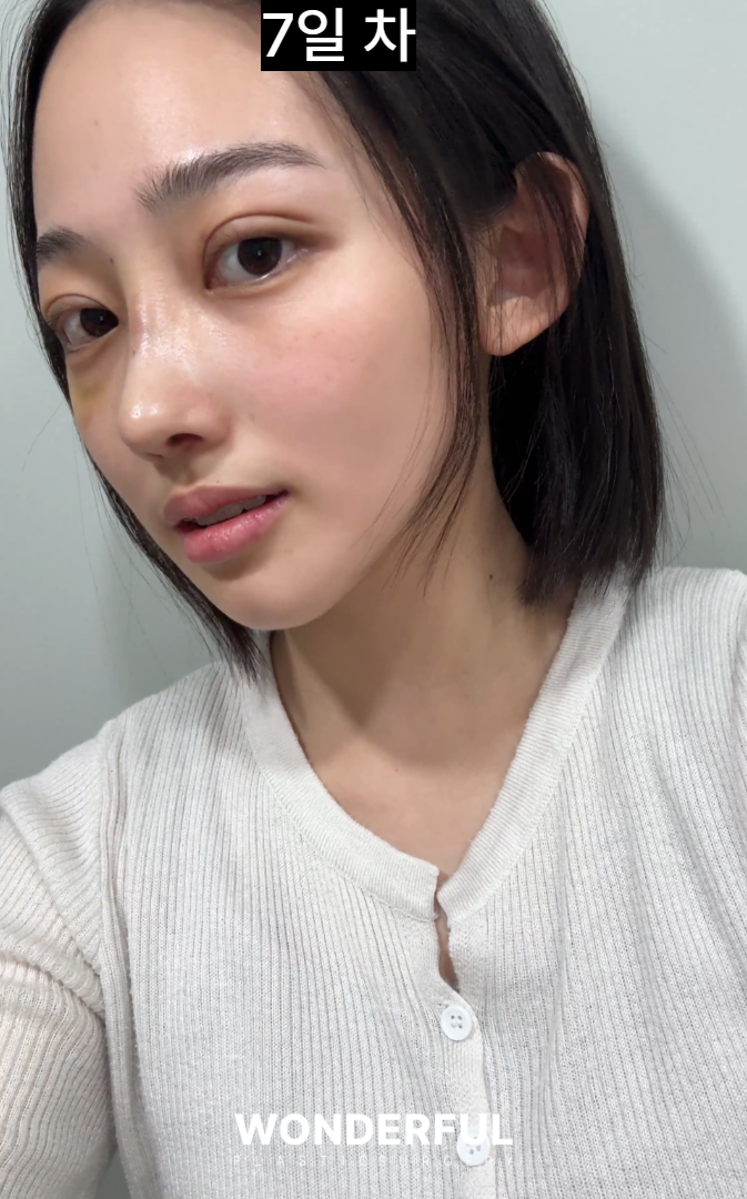 코에서 냄새가 났어요...염증코 재수술 한달 후기 사진 7