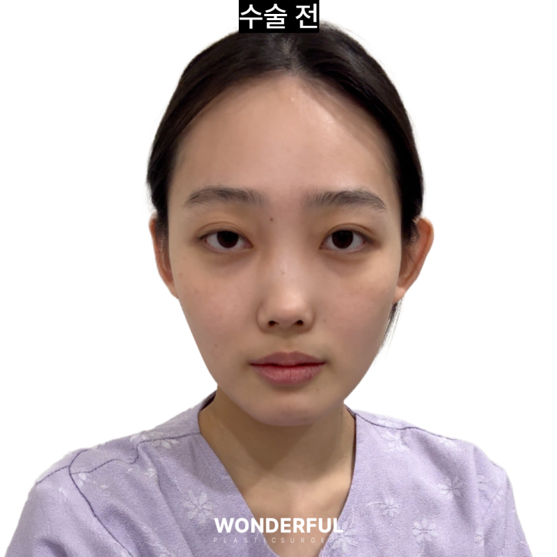 코에서 냄새가 났어요...염증코 재수술 한달 후기 사진 3