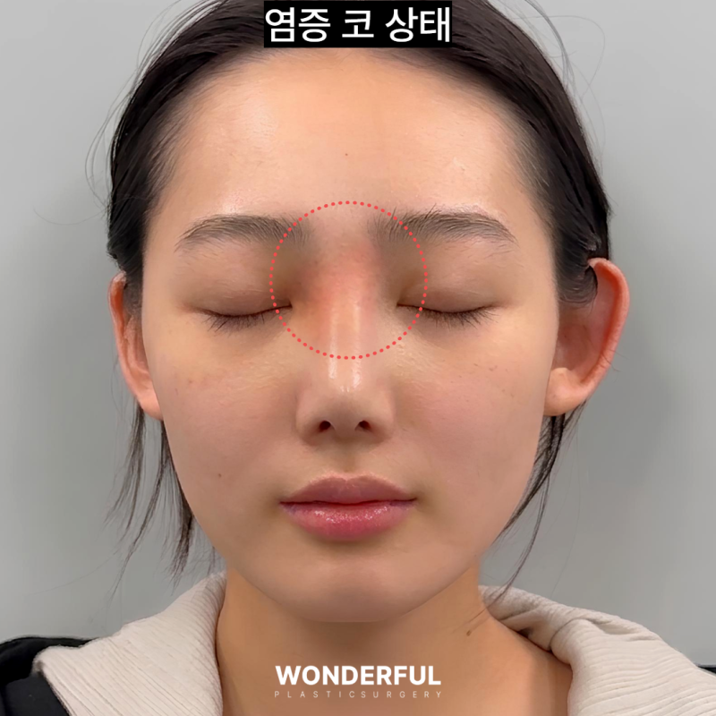 코에서 냄새가 났어요...염증코 재수술 한달 후기 사진 2