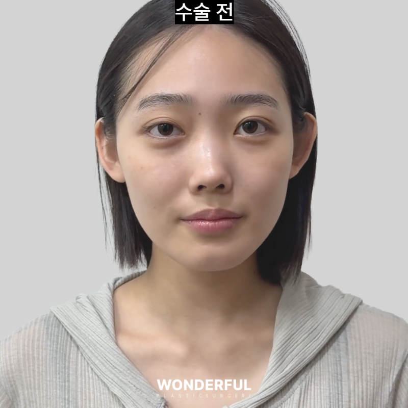 코에서 냄새가 났어요...염증코 재수술 한달 후기