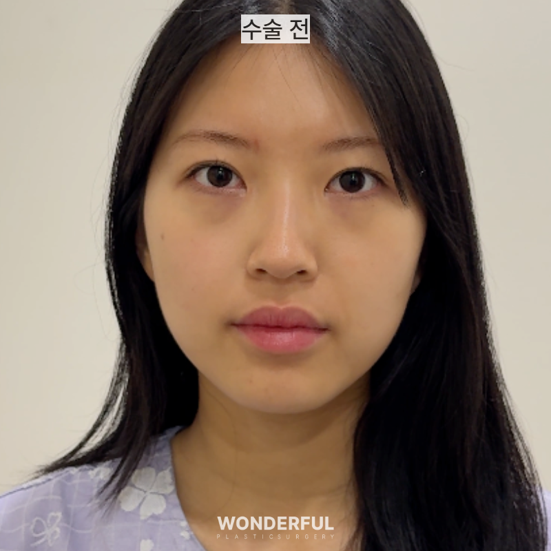 뒤밑트임 한달 후기