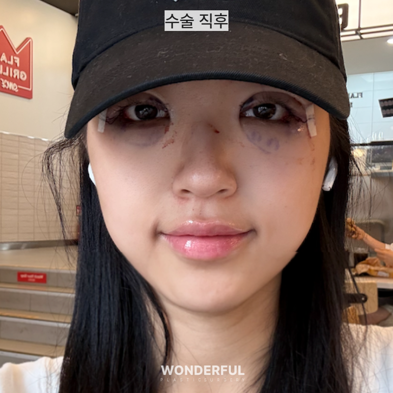 뒤밑트임 한달 후기