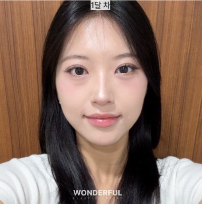뒤밑트임 한달 후기 사진 6