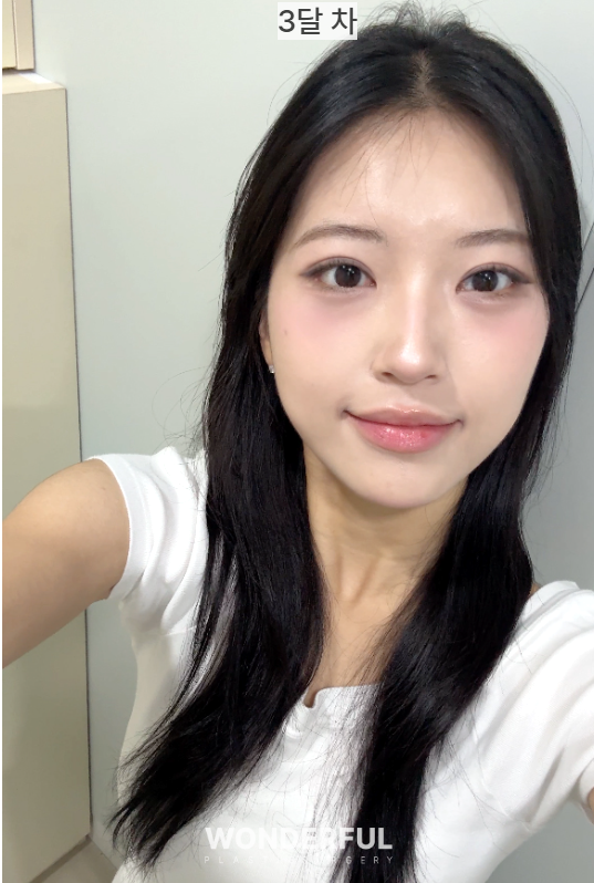 뒤밑트임 한달 후기 사진 7
