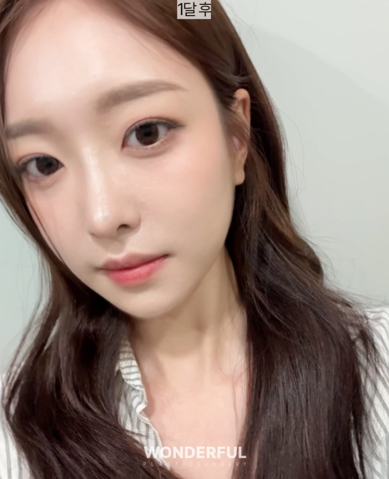 돌출눈도 쌍꺼풀수술이 잘 될까요? 수술 전 꼭 알아야 할 5가지 사진 7