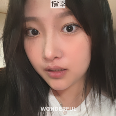 돌출눈도 쌍꺼풀수술이 잘 될까요? 수술 전 꼭 알아야 할 5가지 사진 5