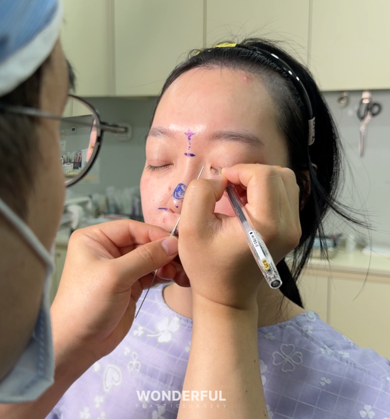 돌출눈도 쌍꺼풀수술이 잘 될까요? 수술 전 꼭 알아야 할 5가지