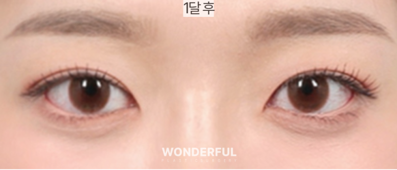 돌출눈도 쌍꺼풀수술이 잘 될까요? 수술 전 꼭 알아야 할 5가지 사진 3